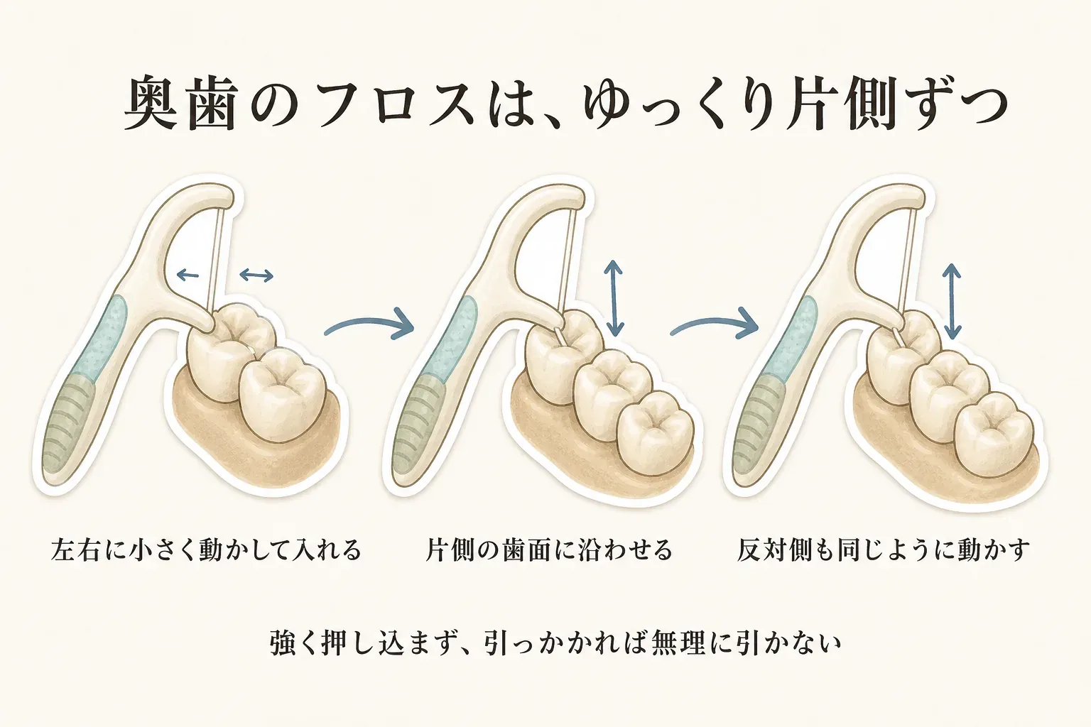 奥歯のY字フロスの使い方として、左右に小さく動かして入れ、片側の歯面に沿わせ、反対側も同じように動かす3段階を示す図。強く押し込まず、引っかかれば無理に引かないよう案内