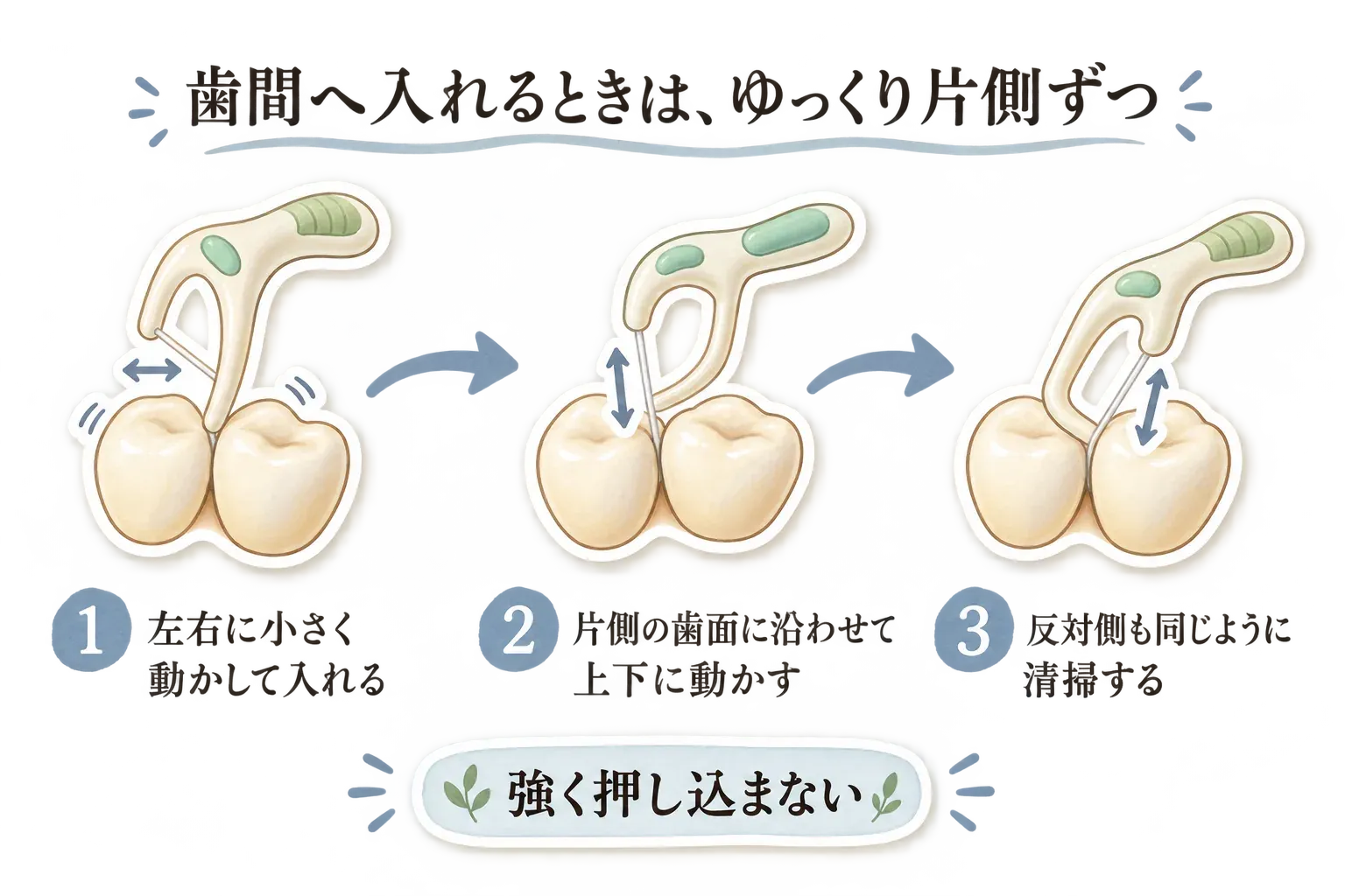 Y字フロスを歯間へ入れる手順を3段階で示す図。左右に小さく動かしてゆっくり入れ、片側の歯面に沿わせて上下に動かし、反対側も同じように清掃する。強く押し込まないよう案内している